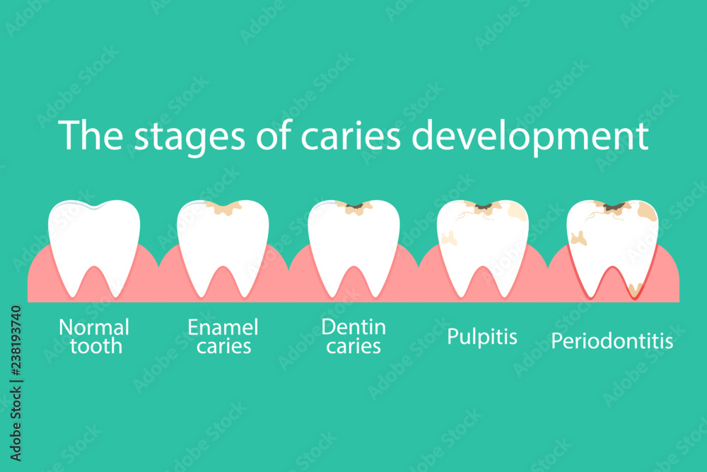 Stomatological concept. Development of dental caries, pathogenic ...