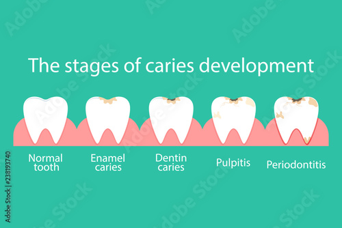 Stomatological concept. Development of dental caries, pathogenic microflora in the oral cavity. Vector illustration.