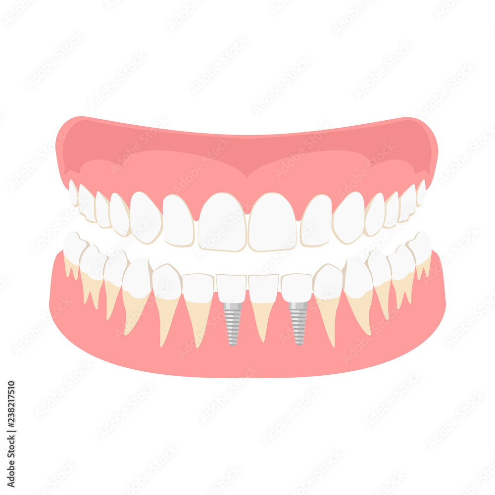 Obraz premium Dental implantation. Healthy human teeth and Dental implant. dental implant. Vector illustration
