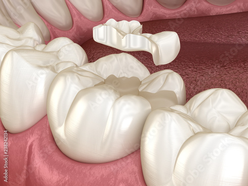 Inlay ceramic crown fixation over tooth. Medically accurate 3D illustration of human teeth treatment