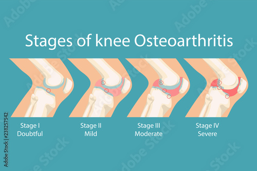 Stages of knee Osteoarthritis. Human Knee Osteoarthritis infographics. Vector illustration. 