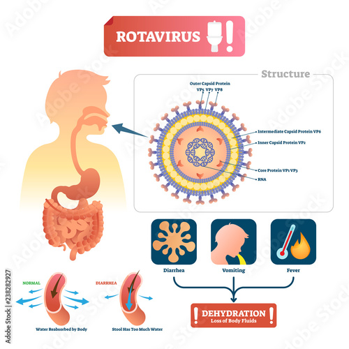 Rotavirus vector illustration. Labeled stomach medical disease with symptom