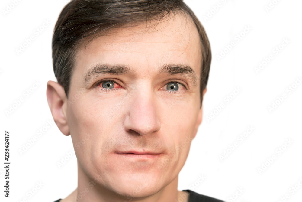 Middle-aged man on a white background with a sick eye on conjunctiva. A man has a sad face Middle-aged man on a white background with a sick eye on conjunctiva. A man has a sad face