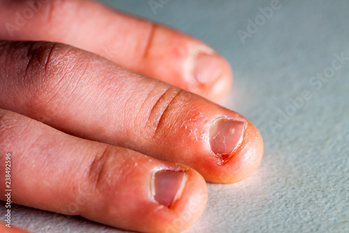 Close up of hand with bitten finger and fingernails.