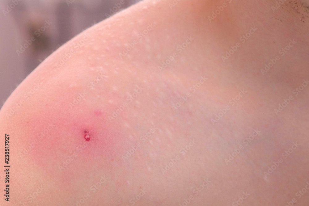 Big red pimple on a man's shoulder close-up view. Big red pimple on a man's shoulder close-up view.