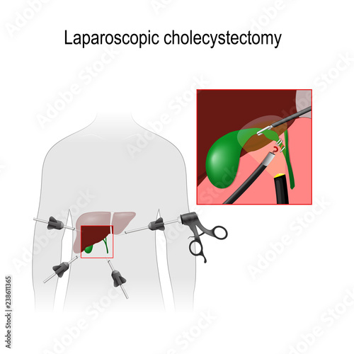 Laparoscopic Cholecystectomy