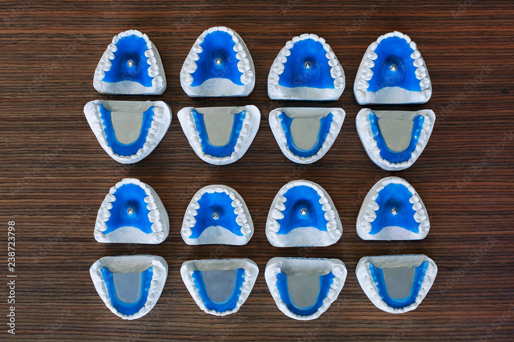 plaster impressions - jaws model with support pins for bite registration plaster impressions - jaws model with support pins for bite registration
