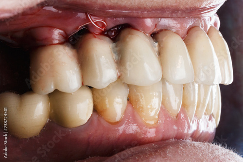 Dental prosthesis is mounted in the oral cavity, removed at an angle