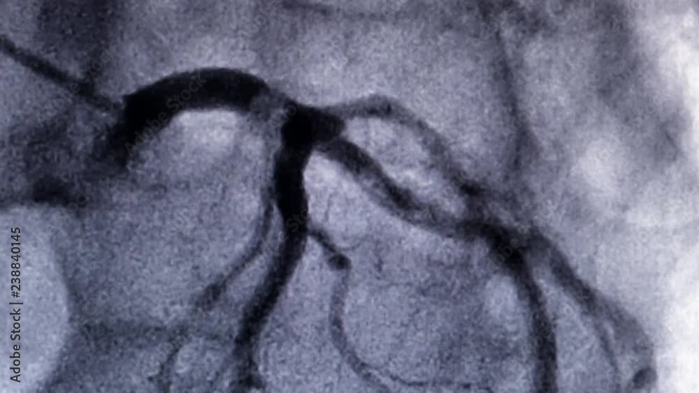 Vidéo Stock Catheterization. Cardiac ventriculography is a medical