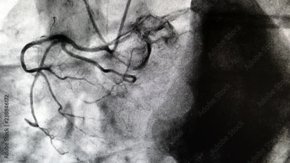Catheterization. Cardiac ventriculography is a medical imaging test