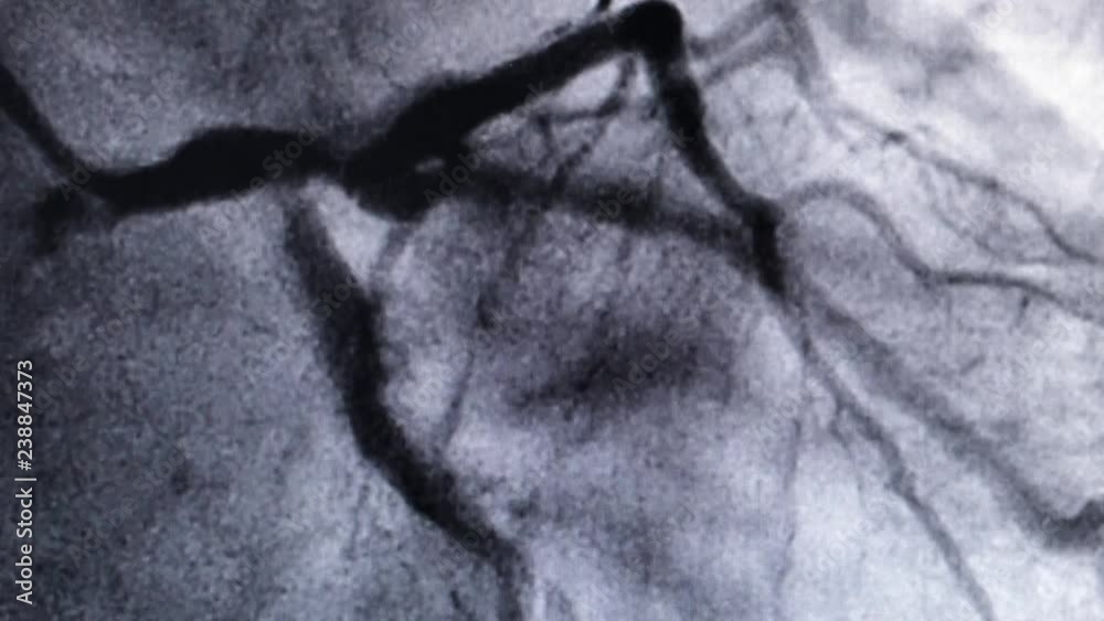 Catheterization. Cardiac ventriculography is a medical imaging test