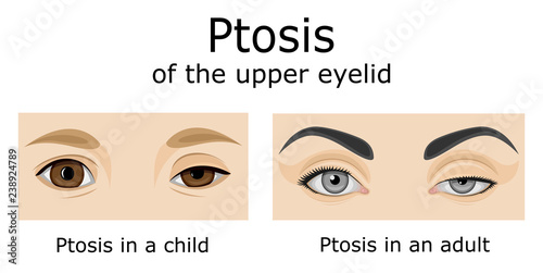 Illustration of Ptosis of the upper eyelid photo