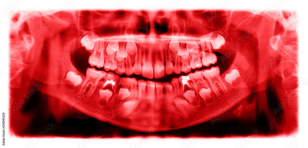 Obraz premium Panoramic radiograph is a scanning dental X-ray of the upper jaw maxilla and lower jawbone mandible a child aged 7 seven years.