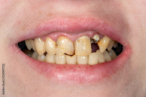 broken tooth closeup. Girl at the dental reception