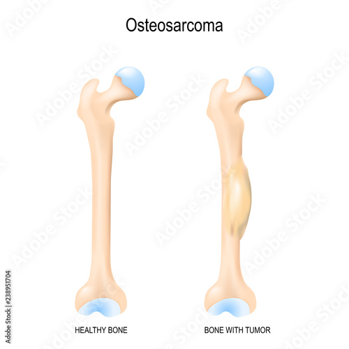 Two human bones: healthy femur and bone with osteosarcoma