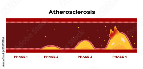 step of Atherosclerosis graphic vector . fat stuck in the blood artery cholesterol