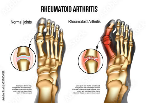 Rheumatoid arthritis Bones the of foot