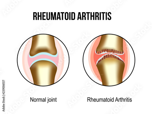Normal and rheumatoid arthritis joints