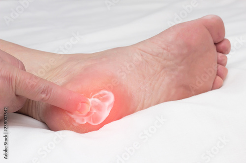 A woman rubs a healing balm cream for the treatment of thorns and osteophytes, a spot spur in the heel, removal of inflammation, close-up, medical photo