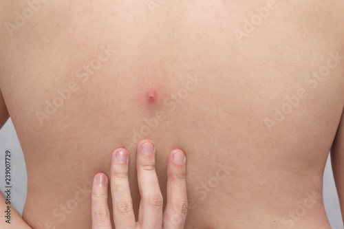 Big red pimple on a man's back, abscess, close-up, medical, blain