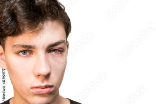 A boy of teenage age with a suffering face on a white background. The teenager suffers because he has an ache sick with a conjunctivitis