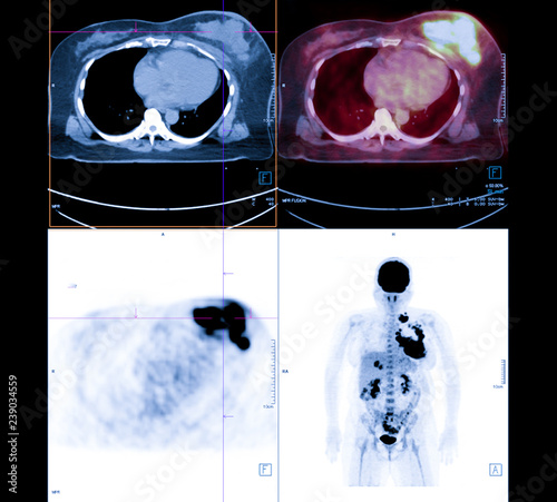 Фотография PET Scan image of whole body Comparision Axial , Coronal  plane in patient breast cancer recurrence treatment