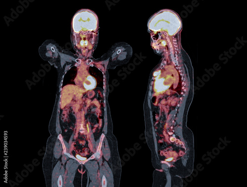 PET CT image of Whole human body coronal and sagittal plane. Positron Emission Tomography Computed Tomography . #239034593