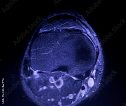 Canvas Print MRI knee meniscus tear scan