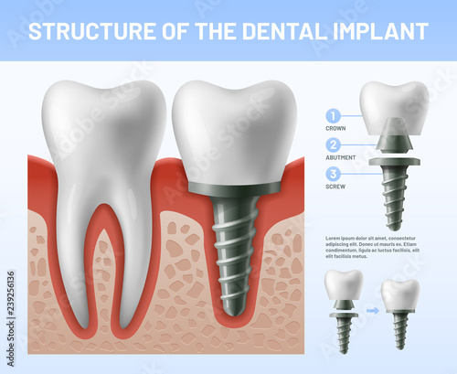 Dental teeth implant. Implantation procedure or tooth crown abutments. Health care vector illustration
