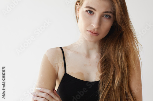 Close up shot of beautiful young European lady with long loose hair looking at camera at with serious facial expression, having pale vitiligo spots on neck and chest. Beauty, skincare and cosmetology