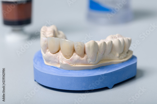 Gebissabdruck und fertiger Zahnersatz im Dentallabor