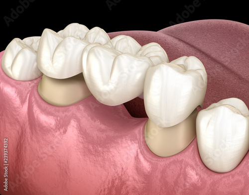Most dentystyczny 3 zębów nad zębem trzonowym i przedtrzonowym. Medycznie dokładna ilustracja 3D leczenia ludzkich zębów