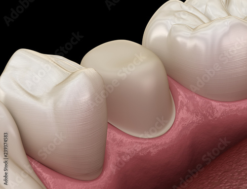 Fototapeta Naklejka Na Ścianę i Meble -  Preparated premolar tooth for dental crown placement. Medically accurate 3D illustration