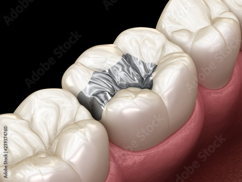 Foto Inlay silver crown fixation over tooth