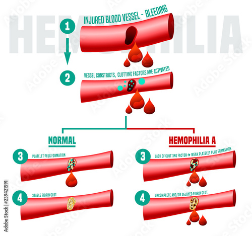 Hemophilia Infographics Poster