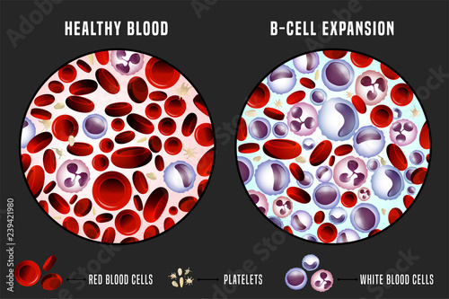 Leukemia Infographic Image photo