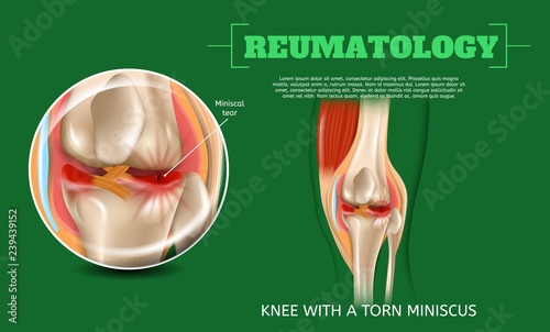 Realistic 3d Illustration Knee with Torn Miniscus