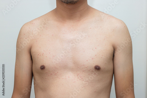 acne bacteria on male body skincare