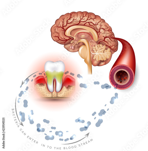 Teeth problems complications, Gum disease inflammation bacteria can enter in to the blood stream an affect brain. Periodontitis disease info poster on a white background