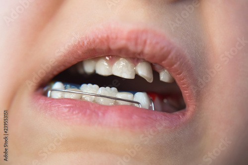 Photo of a little girl's mouth with an orthodontic appliance and crooked teeth.