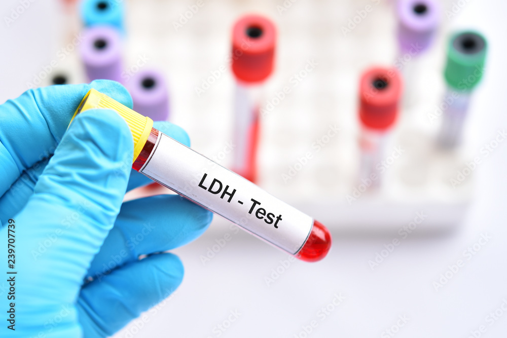 Fototapeta premium Blood sample tube for lactate dehydrogenase or LDH test