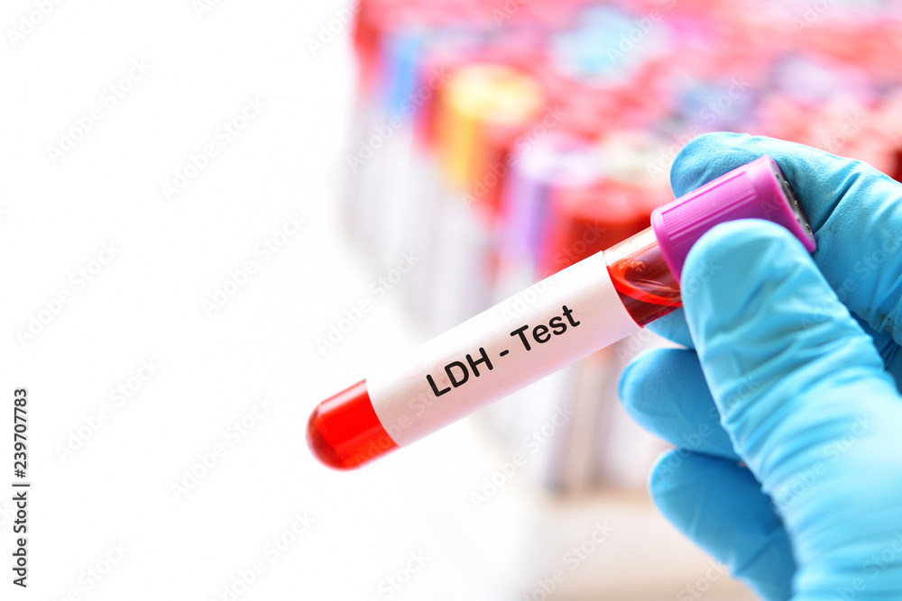 Blood sample tube for lactate dehydrogenase or LDH test
Blood sample tube for lactate dehydrogenase or LDH test