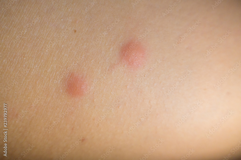 Insect bites on female hand skin Insect bites on female hand skin
