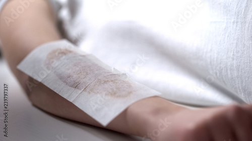 Wax plaster on womans hand, lady making depilation procedures, sugaring