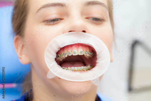Closeup of young woman s teeth with braces and retractor for mouth. Patient at the dentist