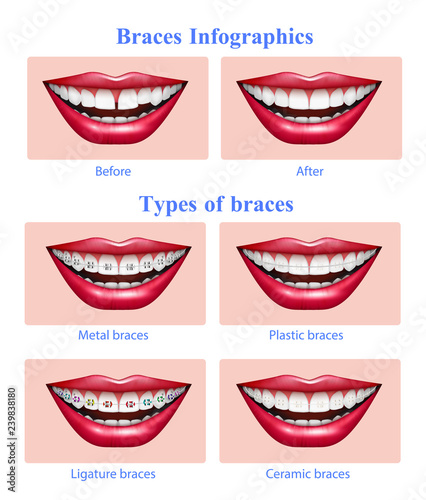 Teeth Braces Types Realistic Infographics 
