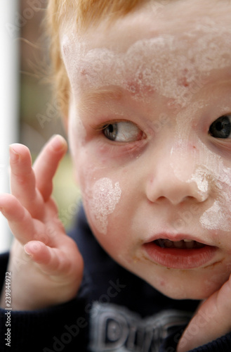 Child with chicken pox spots on face and calamine lotion. photo