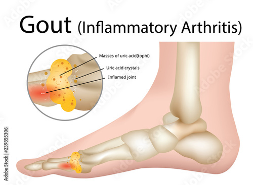 Gout (Inflammatory arthritis) Gout is an intensely painful type of arthritis , Illustration - Vector photo