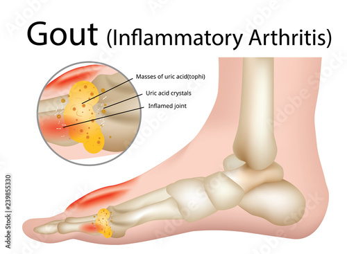 Gout (Inflammatory arthritis) Gout is an intensely painful type of arthritis , Illustration - Vector