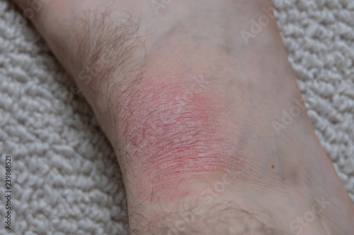 Fényképezés A man with mild Eczema. Dry skin on the foot.